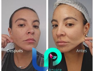 Rejuvenecimiento facial antes y después - 876548