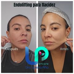 Sculptra o Radiesse - Dra. Lorena Piña