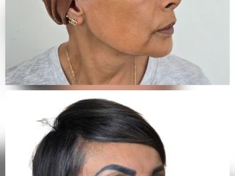 Lifting antes y después - 877119