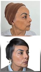 Endolifting  Laser - Dra. Lorena Piña