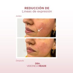 Rejuvenecimiento Facial - Dra. Verónica Meade