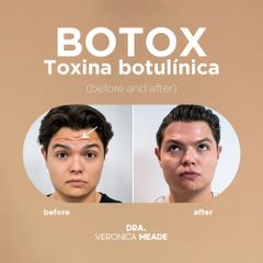 Toxina Botulínica  - Dra. Verónica Meade