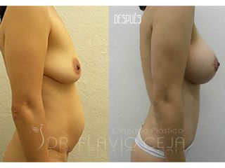 Antes y después de Abdominoplastia