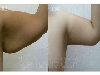 Antes y después de Braquioplastia