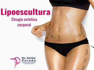 Lipoescultura -Dr. Facundo Javier Parada Ovalle
