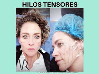 Hilos tensores