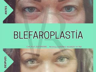 Antes y después de Blefaroplastia