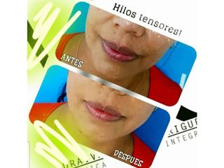 Antes y después de Hilos tensores