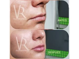 Antes y después de Aumento de labios