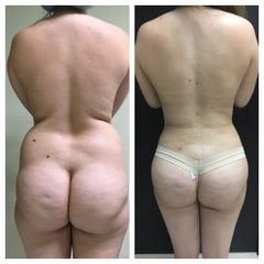 Antes y después de lipoescultura 