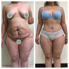 Antes y después de una Abdominoplastia
