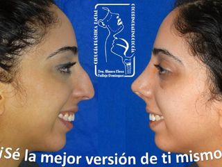 Antes y después de Rinoplastia