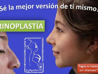 Antes y después de Rinoplastia