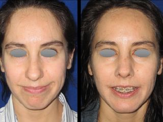 Antes y después de Rinoplastia