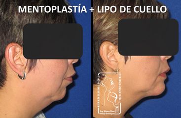 Antes y después de Lipo de cuello y Mentoplastía