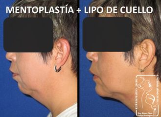 Antes y después de Lipo de cuello y Mentoplastía