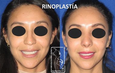 Antes y después de Rinoplastia