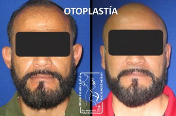 Antes y después de Otoplastia