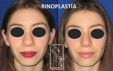 Antes y después de Rinoplastía Mínima Invasión