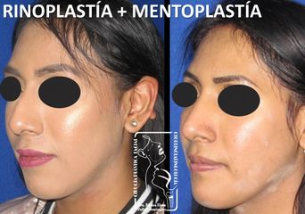 Antes y después de Rinoplastía + Mentoplastía