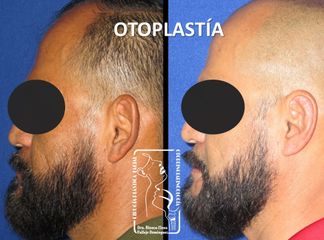 Antes y después de Otoplastia