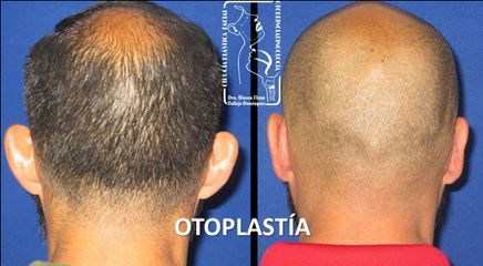 Antes y después de Otoplastia