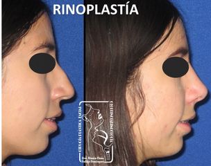 Antes y después de Rinoplastia