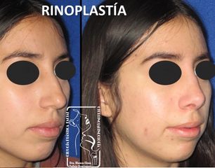 Antes y después de Rinoplastia