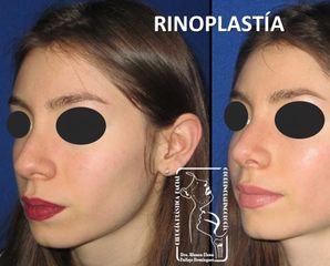 Antes y después de Rinoplastía Mínima Invasión