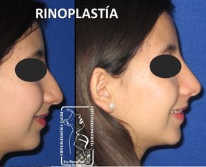 Antes y después de Rinoplastía Mínima Invasión