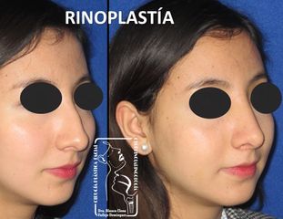 Antes y después de Rinoplastía Mínima Invasión