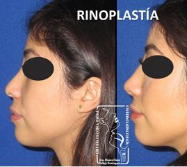 Antes y después de Rinoplastía