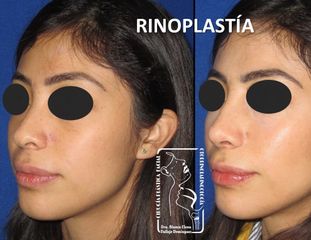 Antes y después de Rinoplastia