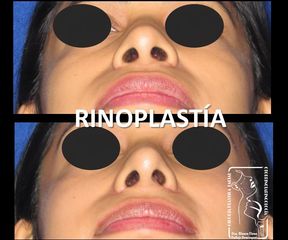 Antes y después de Rinoplastía Mínima Invasión