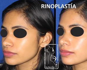 Antes y después de Rinoplastía Mínima Invasión