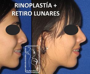 Antes y después de Rinoplastia