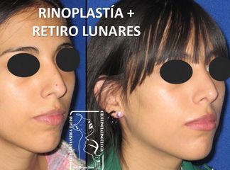 Antes y después de Rinoplastia