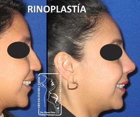 Antes y después de Rinoplastia