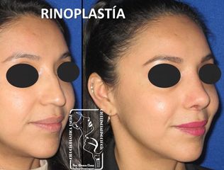 Antes y después de Rinoplastia