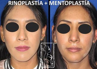 Antes y después de Rinoplastía + Mentoplastía