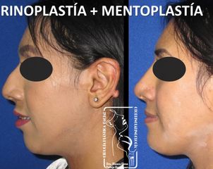 Antes y después de Rinoplastía + Mentoplastía