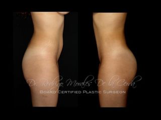 Antes y después de Lipoescultura
