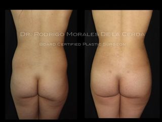 Antes y después de Gluteoplastia