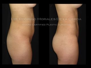 Gluteoplastia (Brazilian Butt Lift)