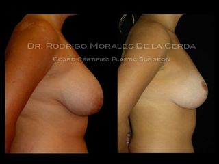 Antes y después de Reducción mamaria