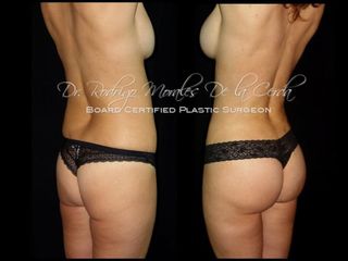 Antes y después de Gluteoplastia 