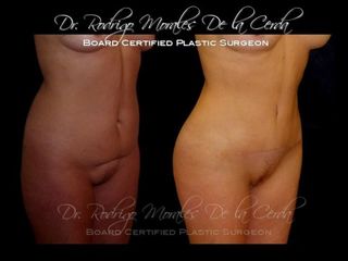 Antes y después de Lipoabdominoplastia