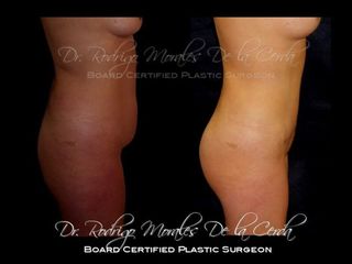 Antes y después de  Lipoabdominoplastia