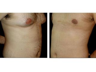 Antes y despues de Ginecomastia 