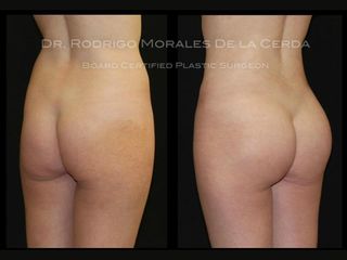 Antes y despues de implantes de gluteos